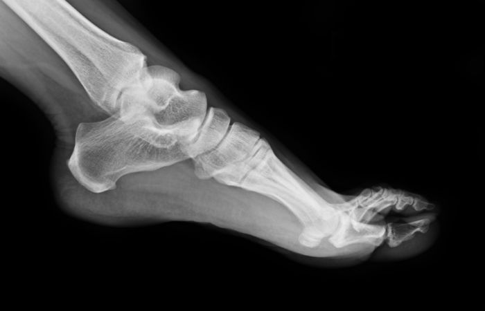 Both Ankle X-Ray